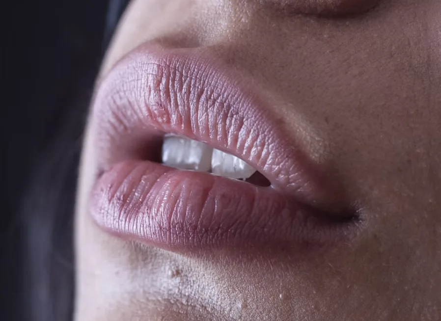 Labbra armoniose — trattamento con filler all'acido ialuronico, Centro Medico Minetti Milano