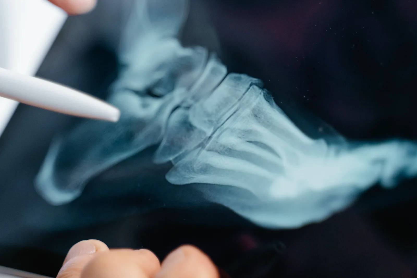 Radiografia del piede — valutazione podologica al Centro Medico Minetti Milano