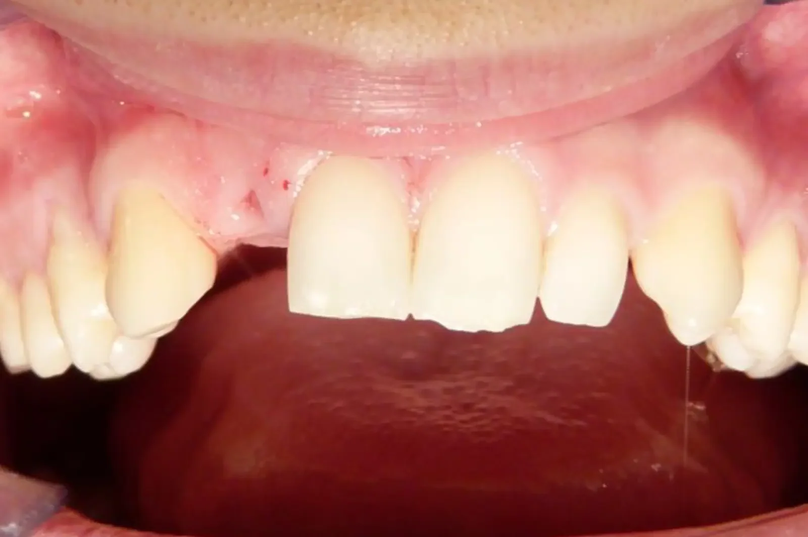 Prima — riabilitazione implantare di un incisivo laterale