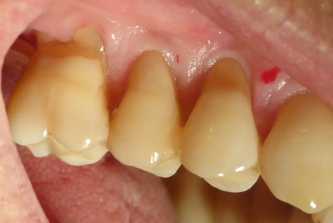 Prima — implantologia dentale
