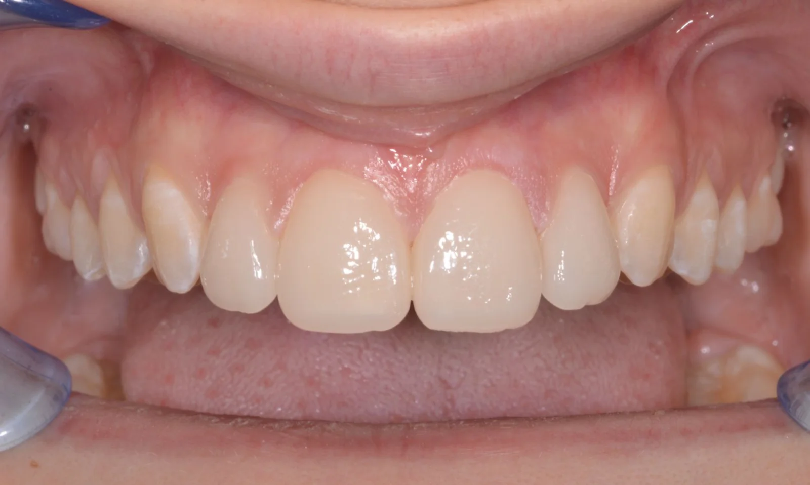 Dopo faccette dentali