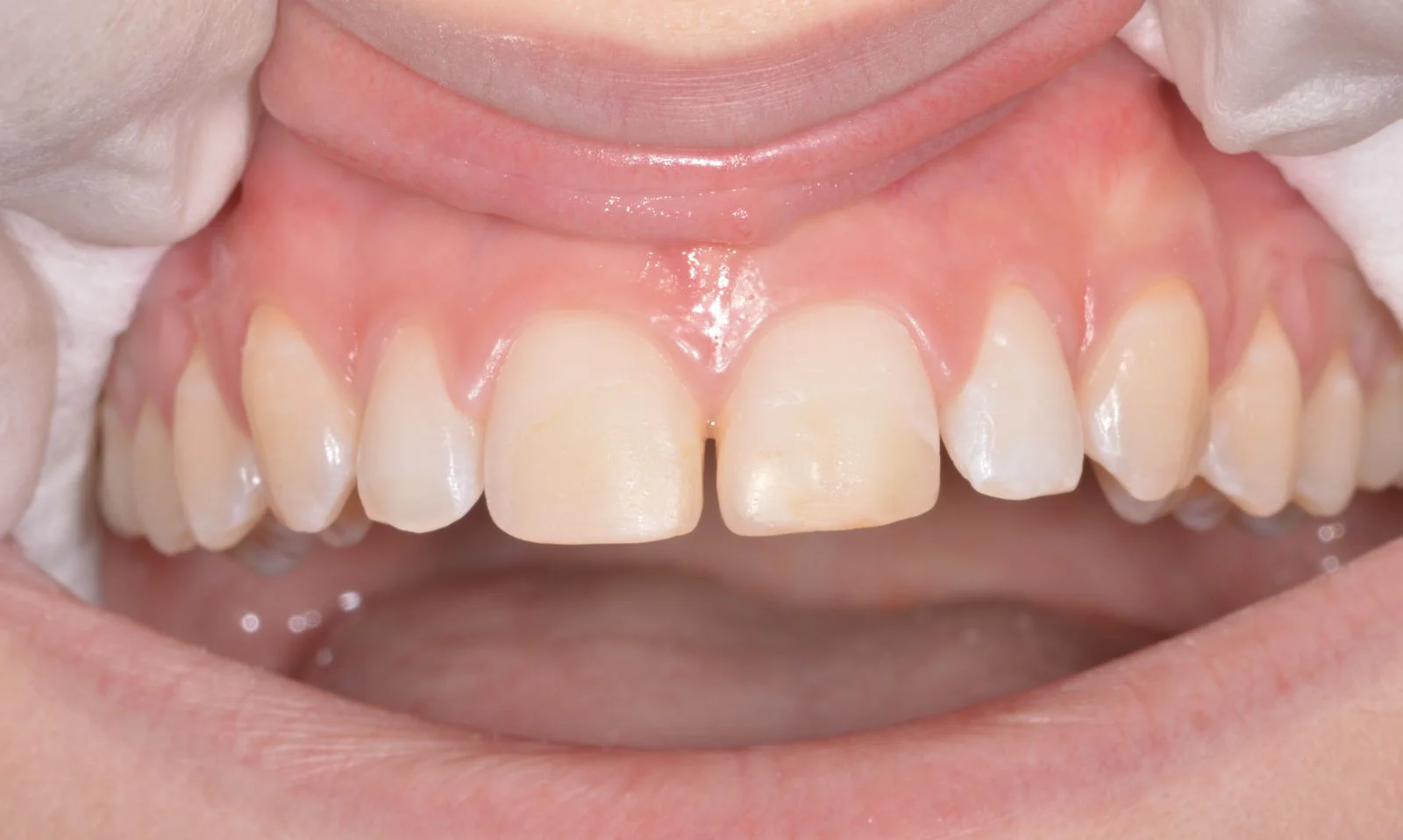 Prima delle faccette dentali