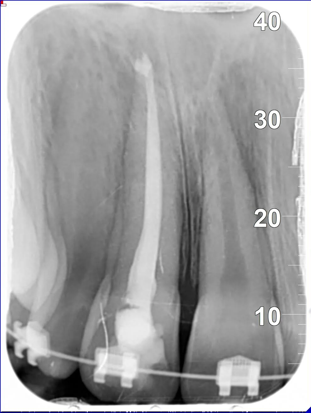 Radiografia periapicale di un trattamento endodontico (devitalizzazione) al Centro Medico Minetti Milano