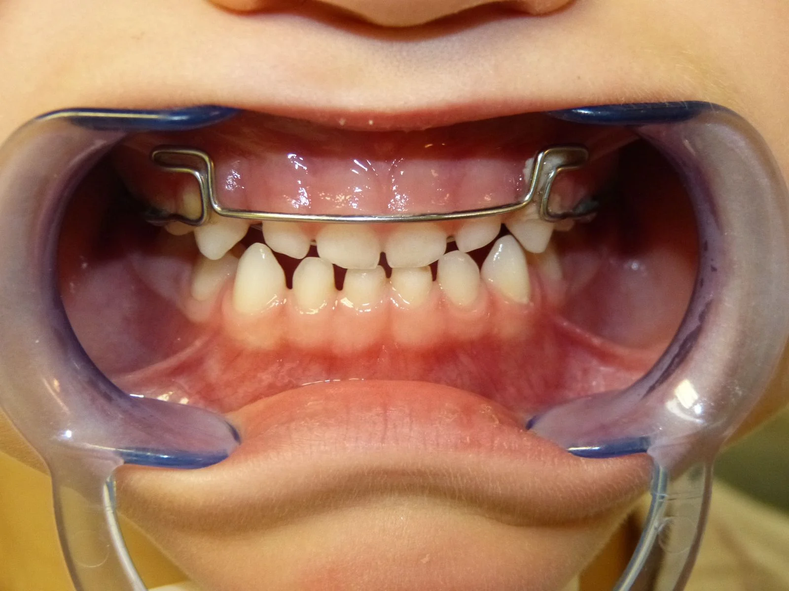 Pedodonzia — bambino dal dentista